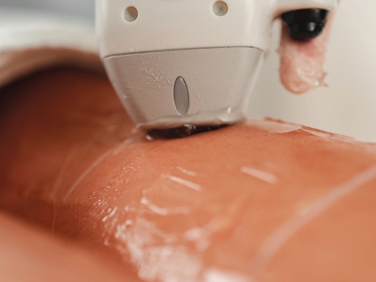 Equipamento a laser para procedimentos de estética